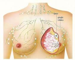mamografia